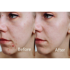 Aphrona LED facial mask, le masque idéal pour votre visage