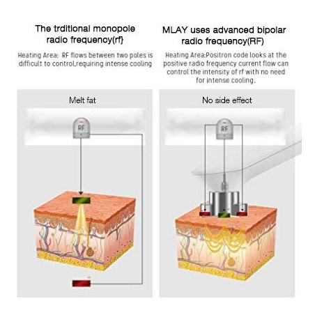 MLAY RF Skin Tightening Device: Professional Anti-Aging for Face & Body - Wrinkle Reduction & Lifting at Home