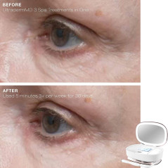 Trophy Skin UltradermMD: At-Home Microdermabrasion for Radiant, Youthful Skin