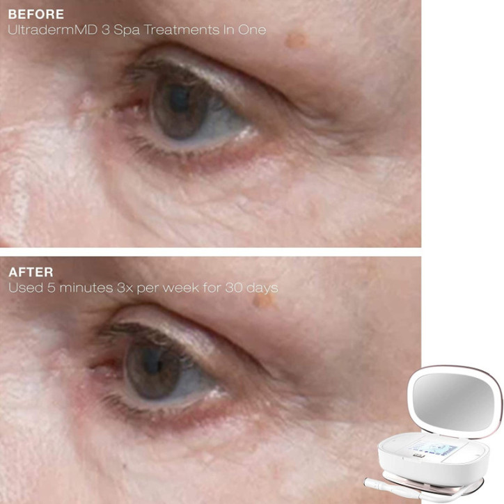 Trophy Skin UltradermMD: At-Home Microdermabrasion for Radiant, Youthful Skin Trophy Skin UltradermMD: At-Home Microdermabrasion for Radiant, Youthful Skin