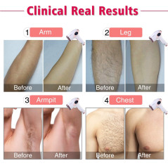 Imene T4, the permanent hair removal device