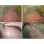 HairMax RegrowMD: Révolution Capillaire au Laser, Résultats Prouvés!