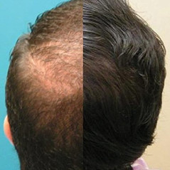 CapillusUltra Mobile Laser Therapy Cap for Hair Regrowth - NEW 6 Minute Flexible-Fitting Model - FDA-Cleared for Medical