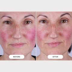 Masque LED CurrentBody Skin Thérapie Série 2 – Efficacité Pro