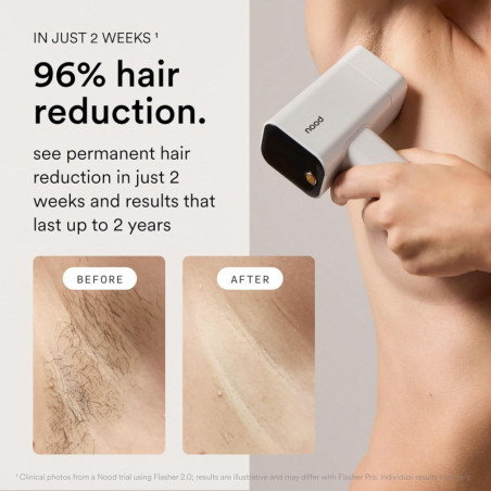 Nood™ NEW Flasher Pro — Appareil IPL & Thérapie Lumière Rouge Anti-Âge, Sans Douleur, Résultats Visibles